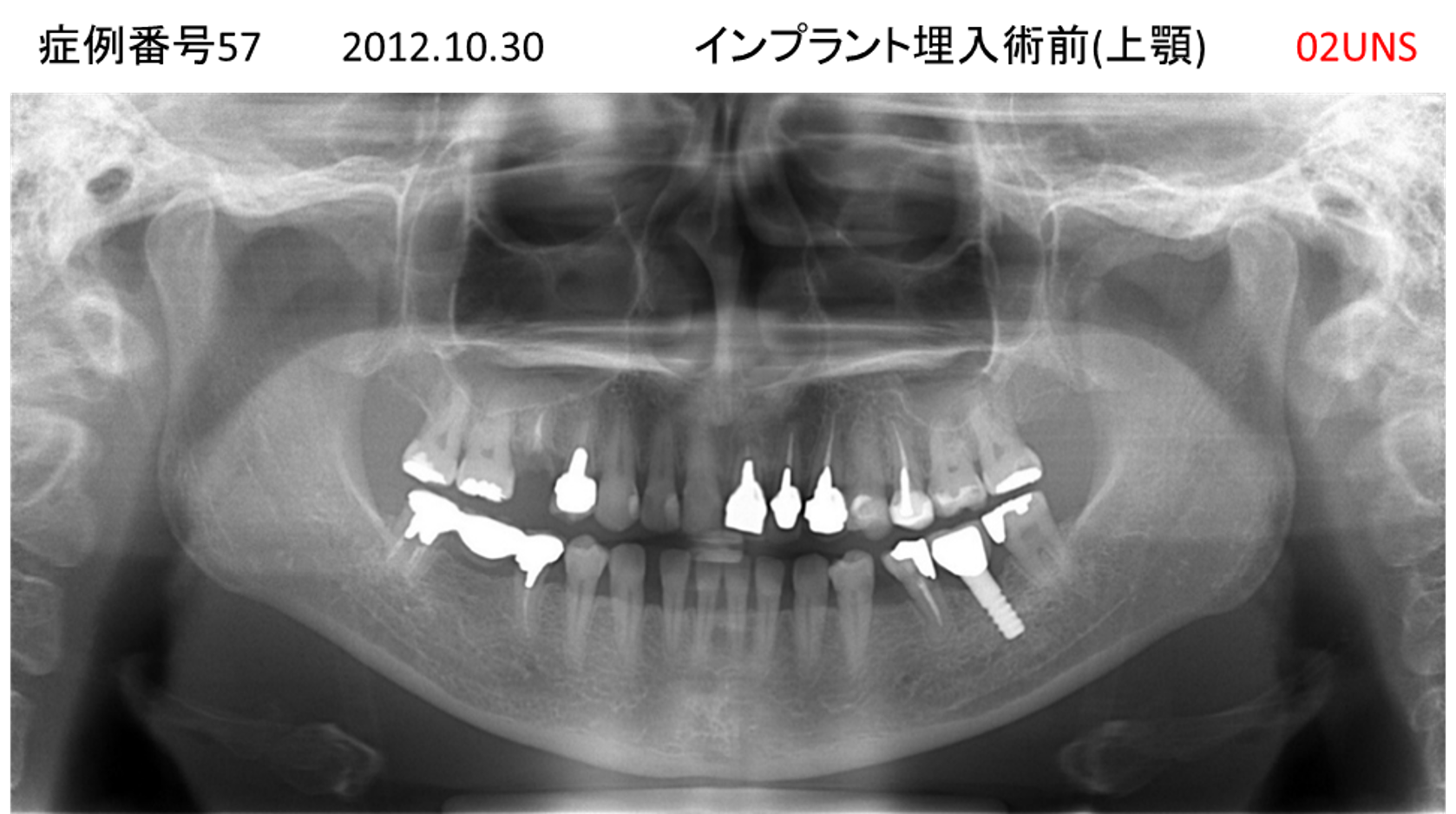 インプラント治療前