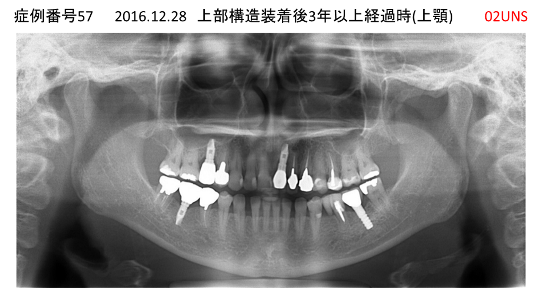 インプラント治療後