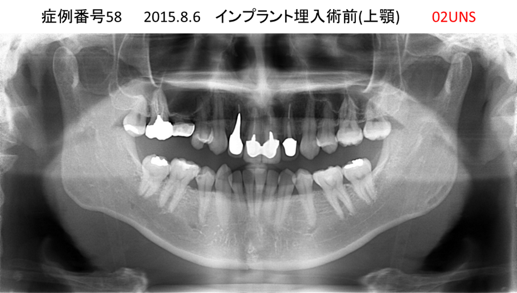 インプラント治療前