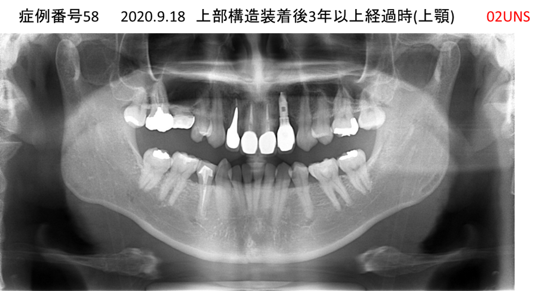 インプラント治療後