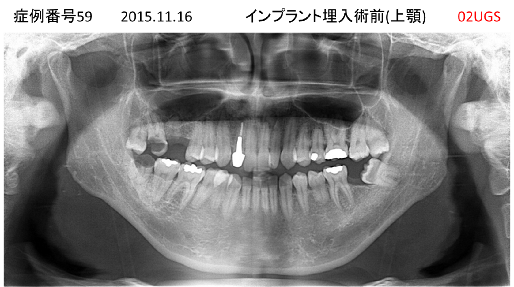 インプラント治療前
