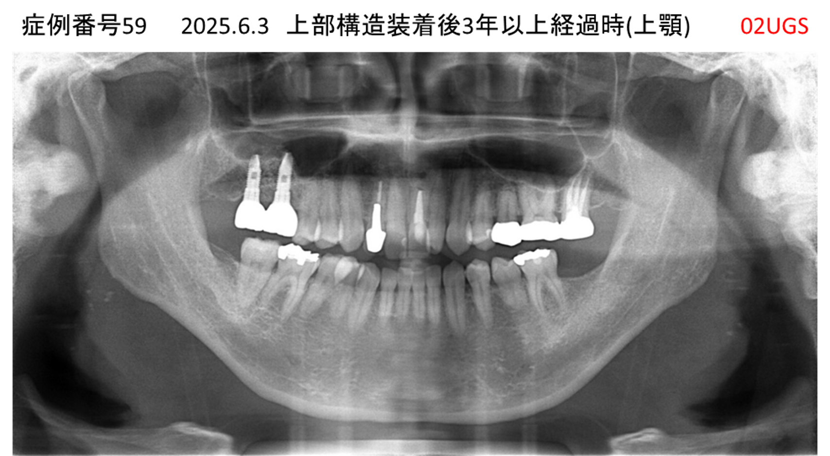 インプラント治療後