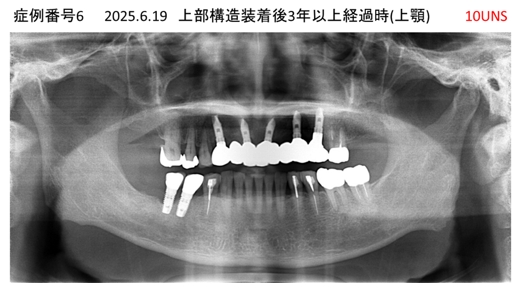インプラント治療後