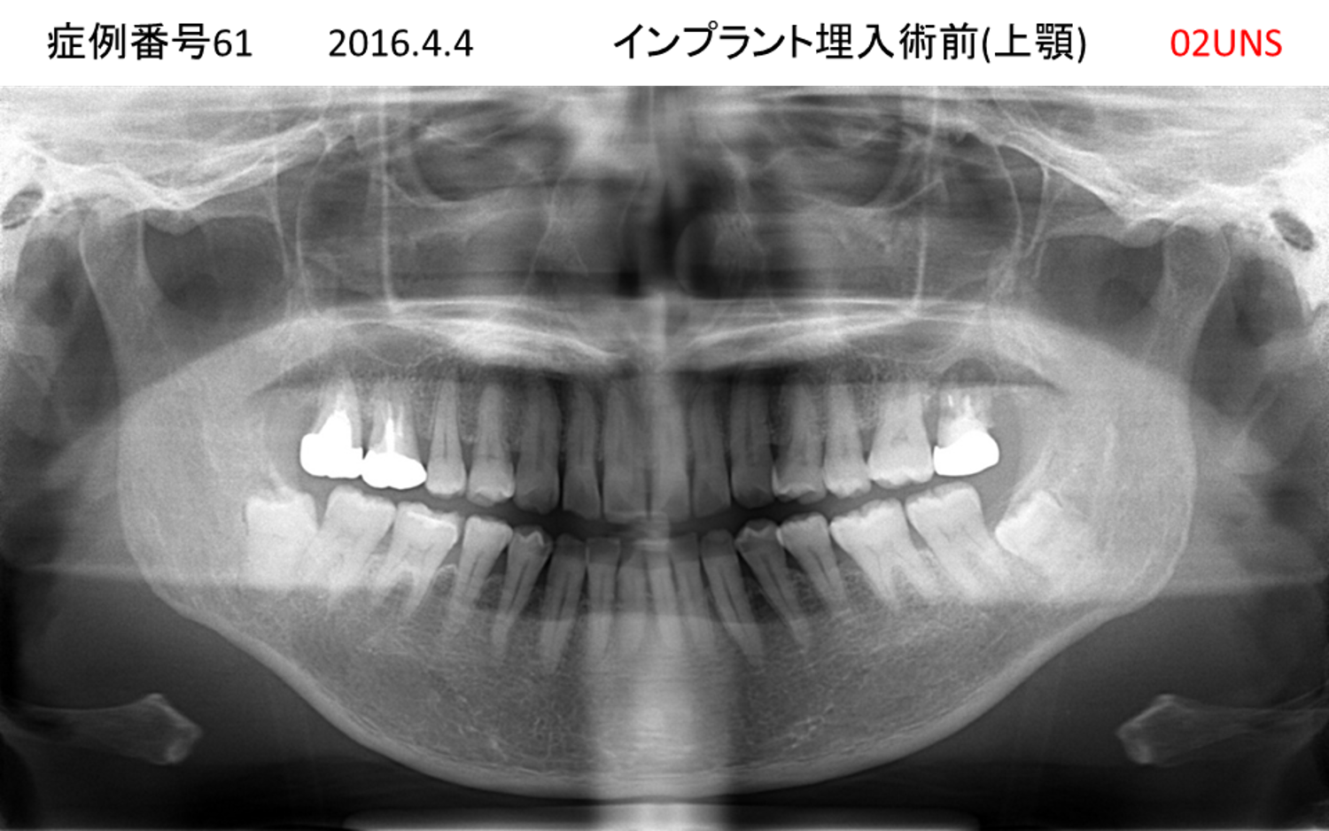 インプラント治療前