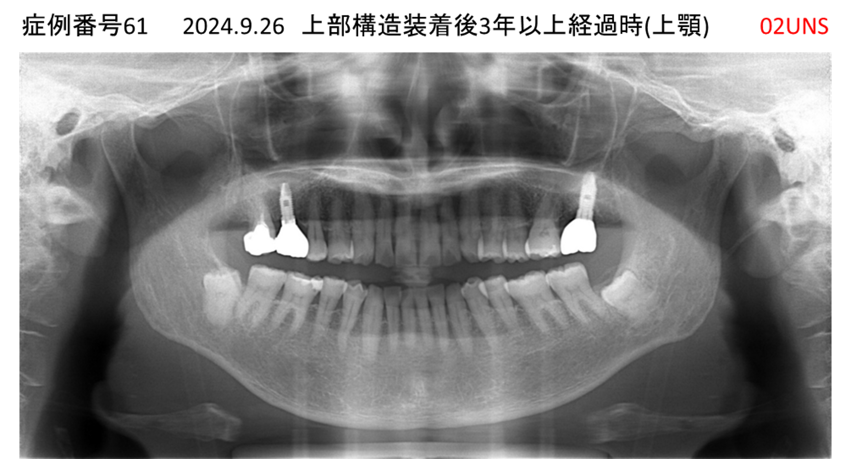 インプラント治療後
