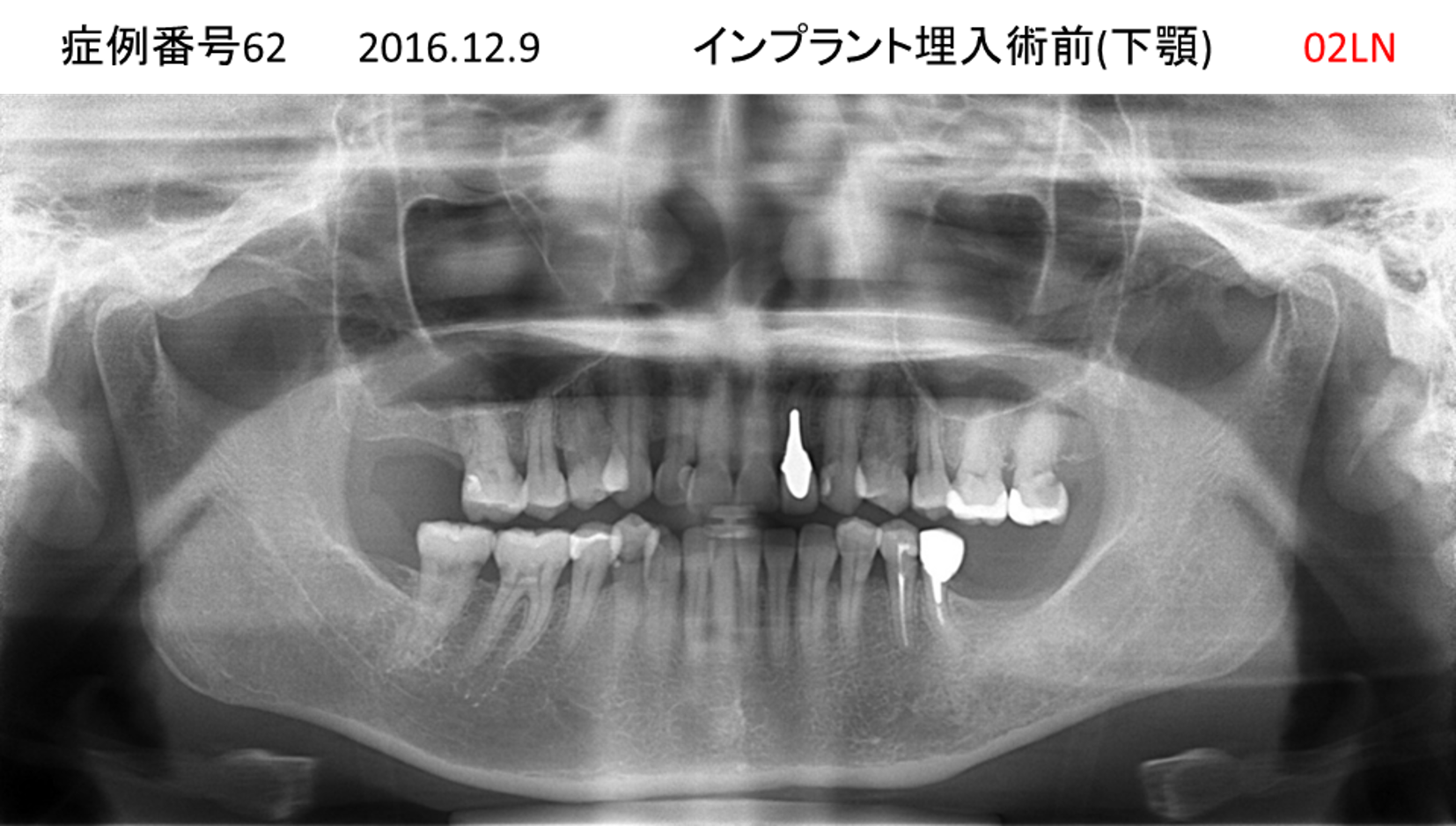 インプラント治療前