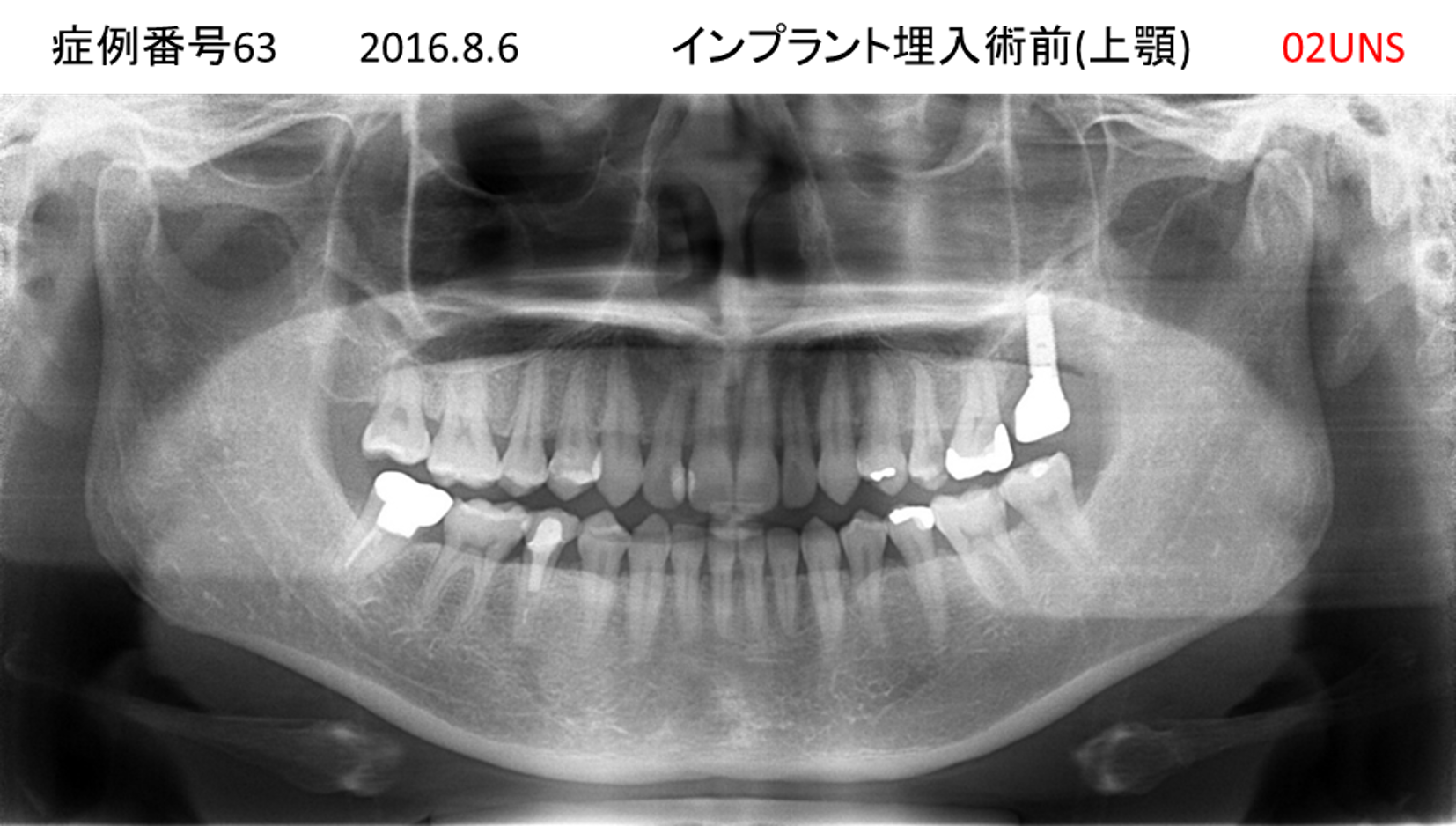 インプラント治療前