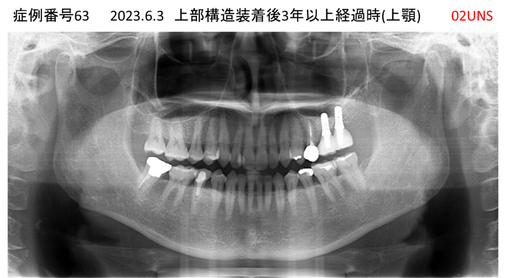 インプラント治療後