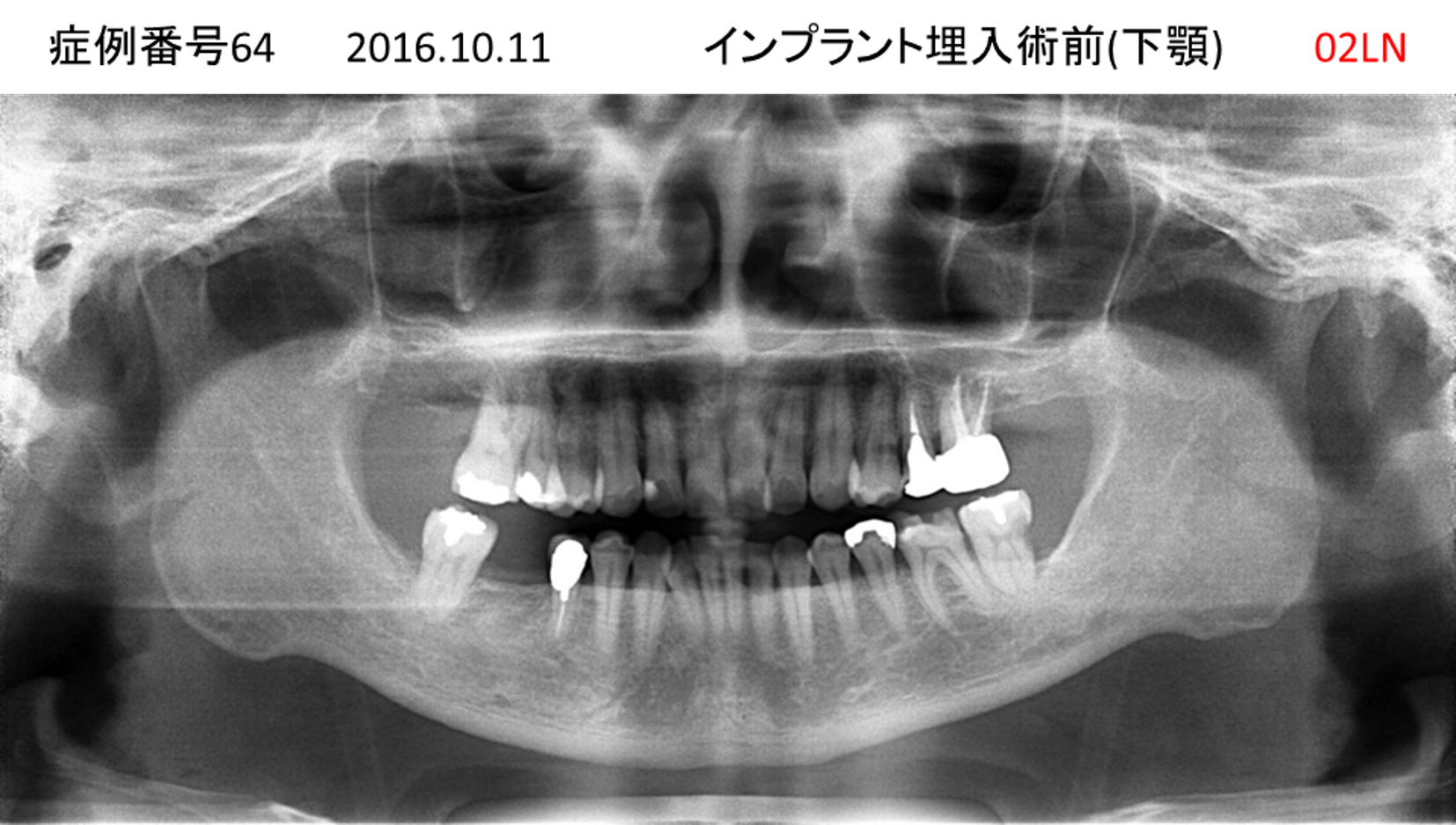 インプラント治療前