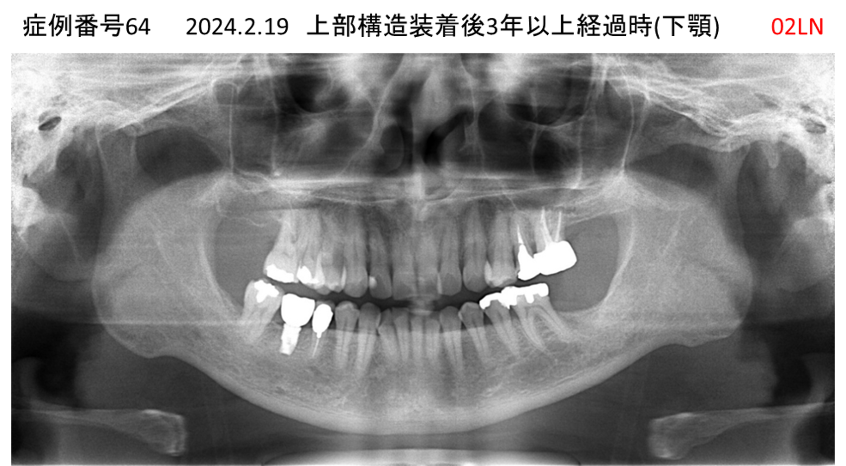 インプラント治療後