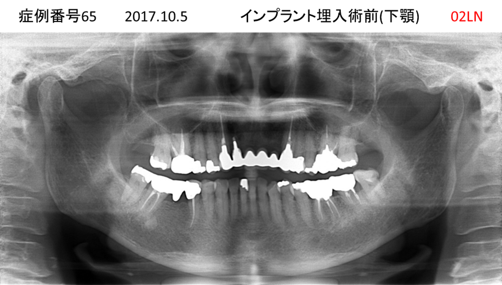 インプラント治療前