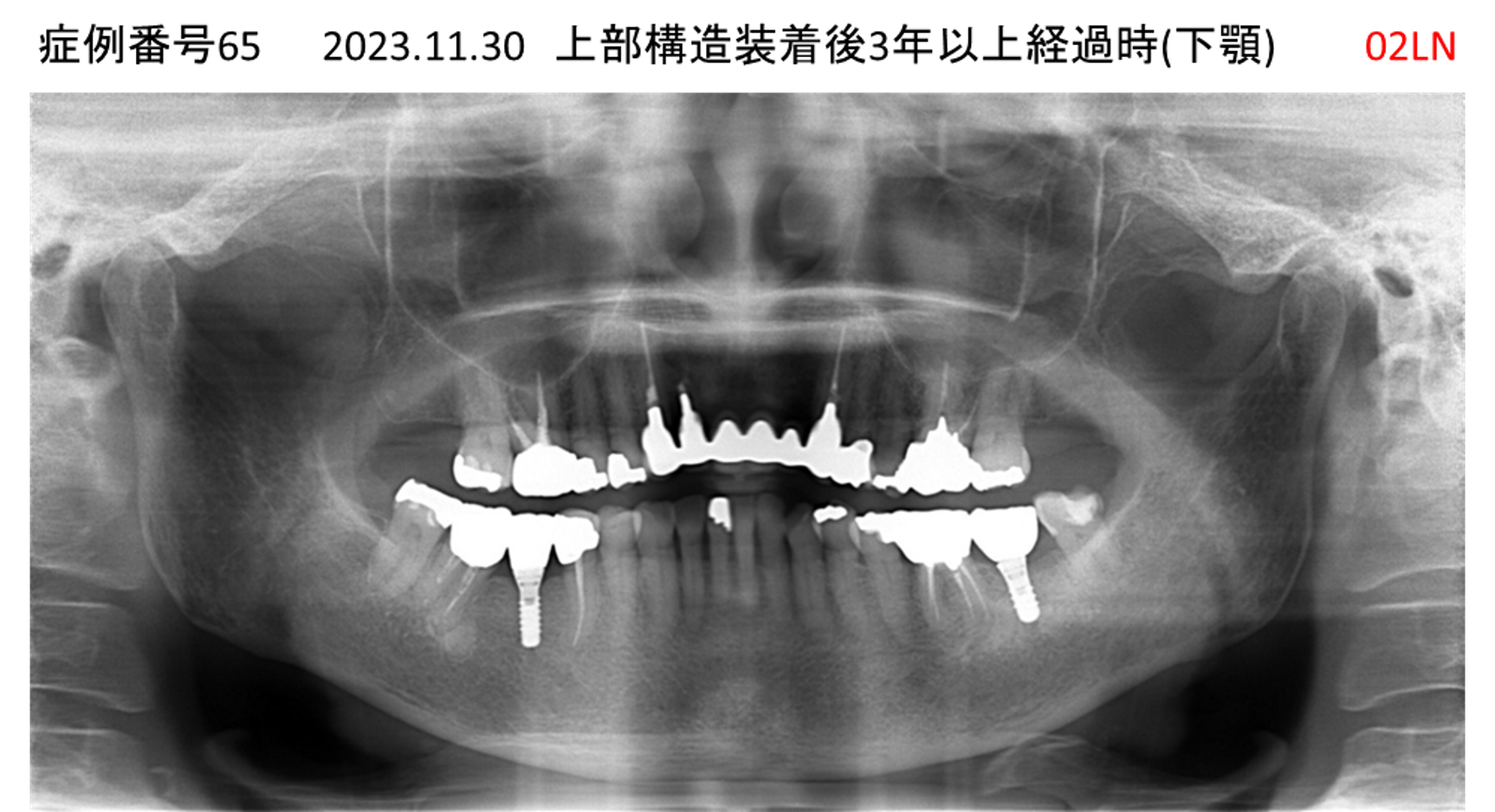 インプラント治療後