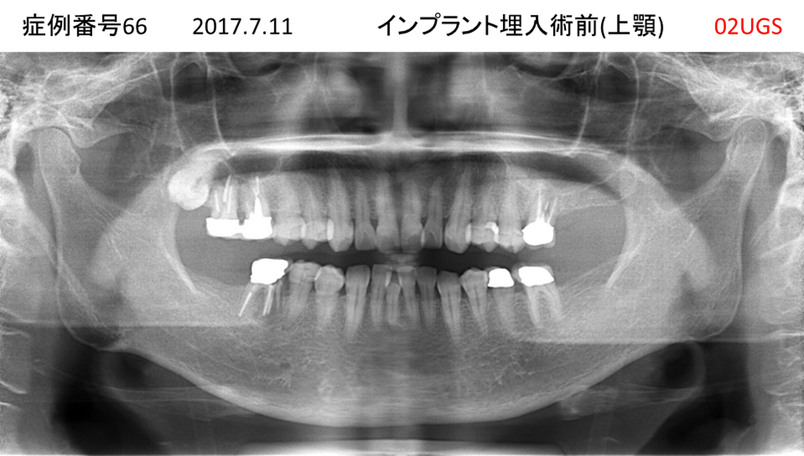 インプラント治療前