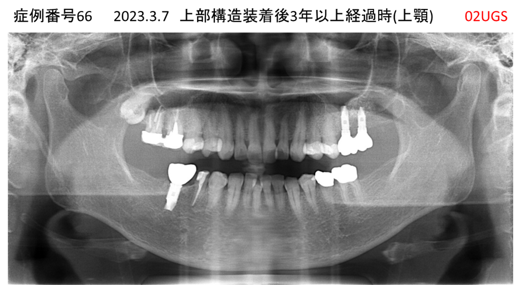 インプラント治療後
