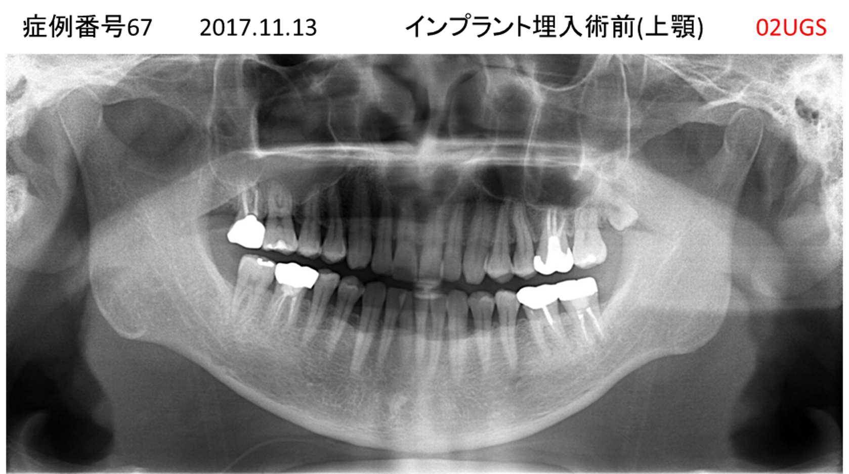 インプラント治療前