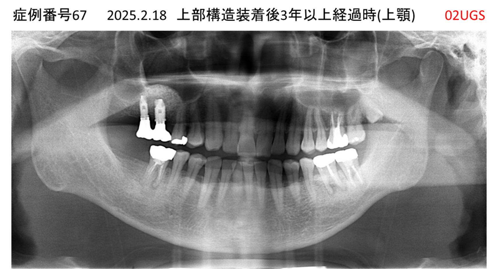 インプラント治療後