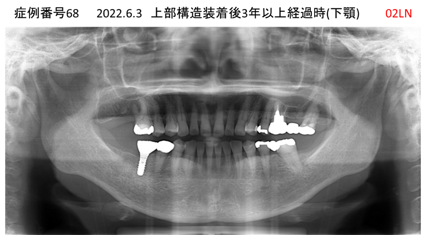 インプラント治療後