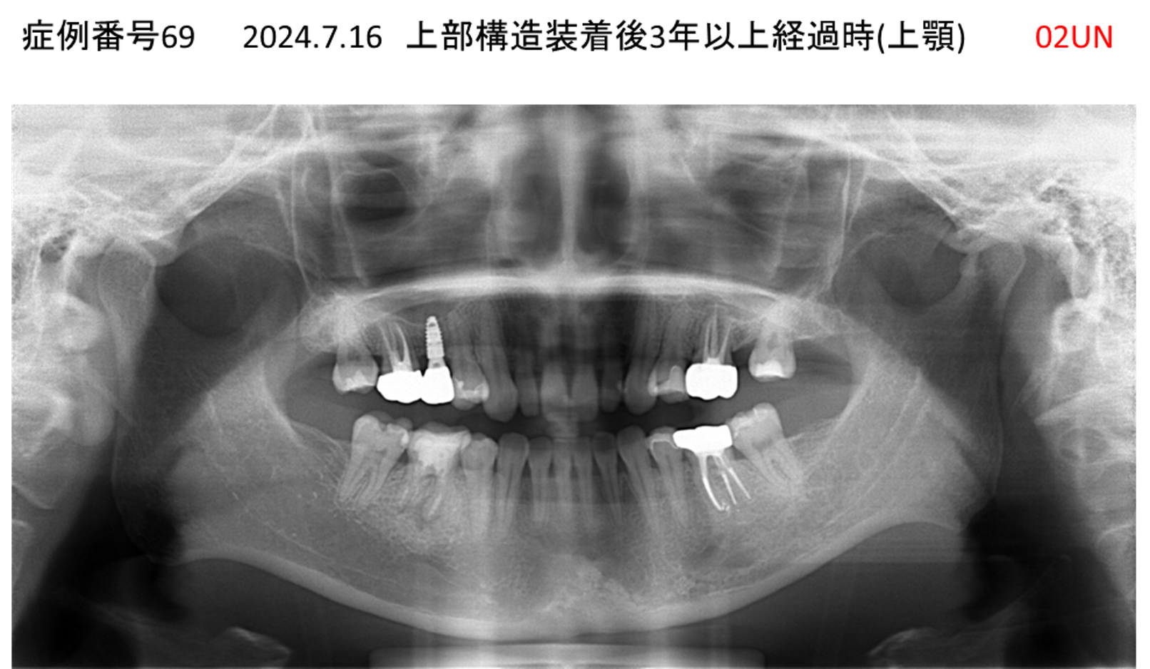 インプラント治療後