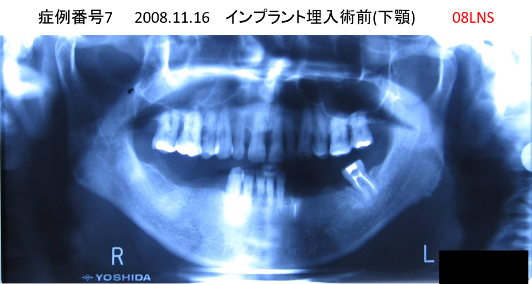 インプラント治療前