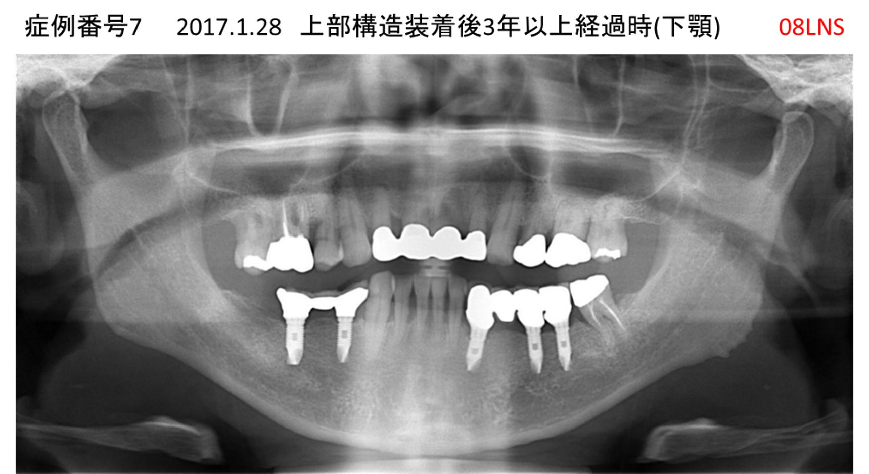 インプラント治療後