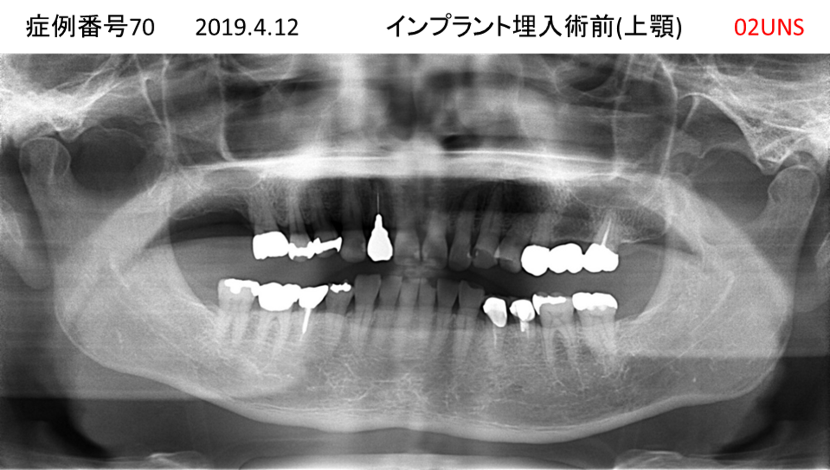 インプラント治療前