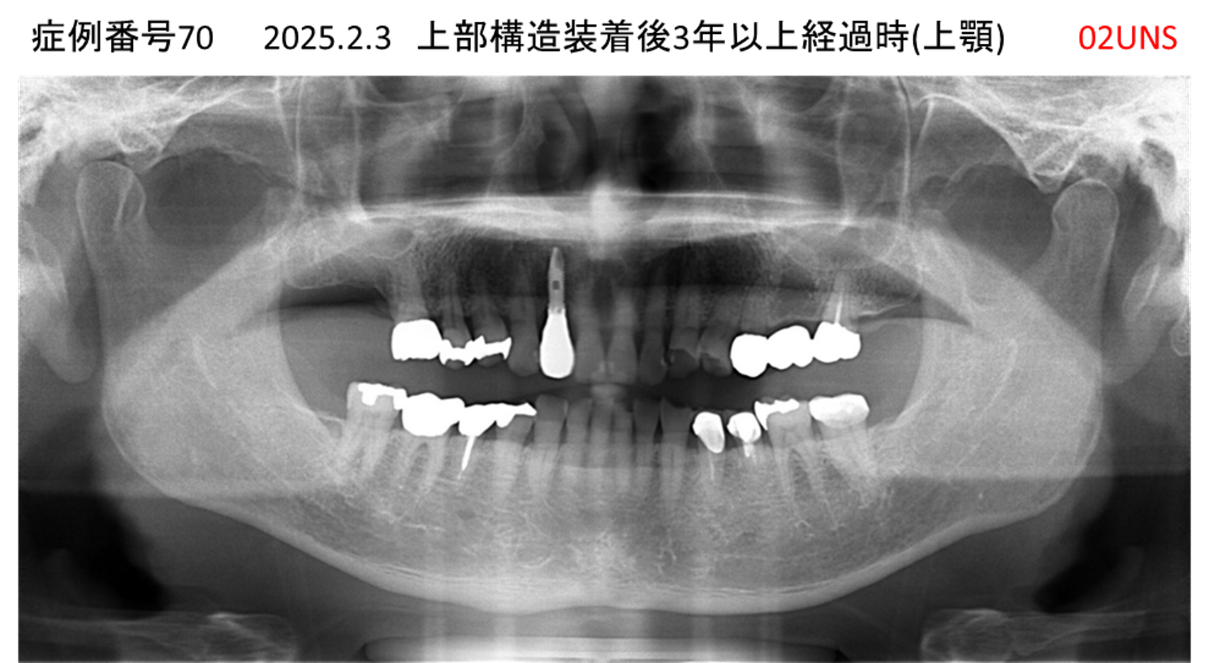 インプラント治療後
