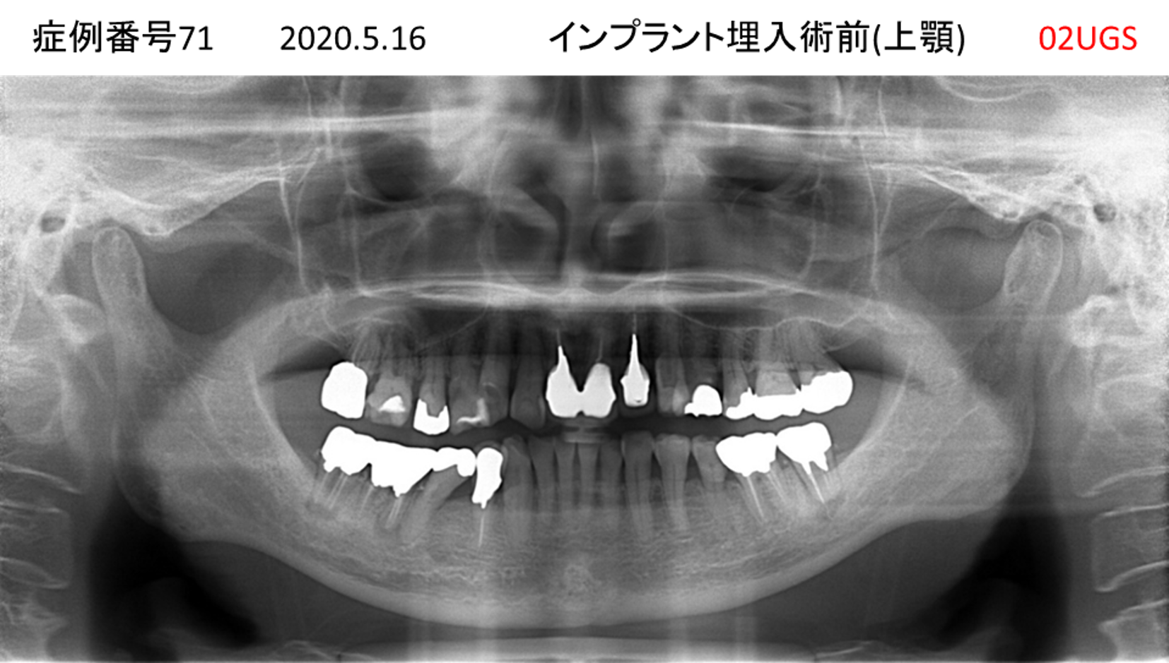 インプラント治療前