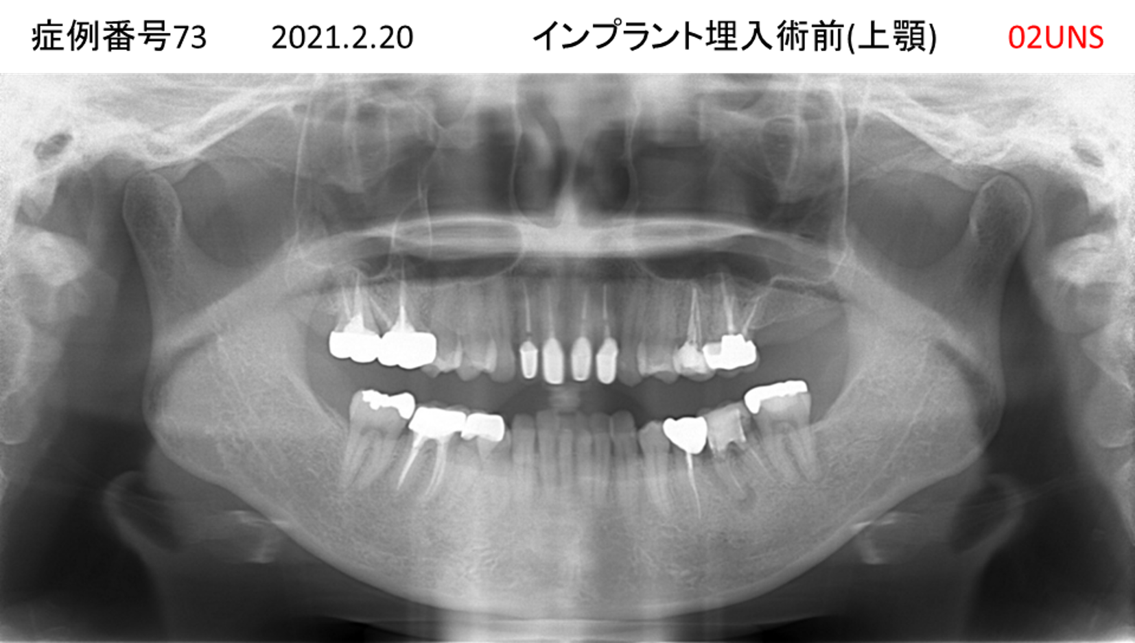 インプラント治療前