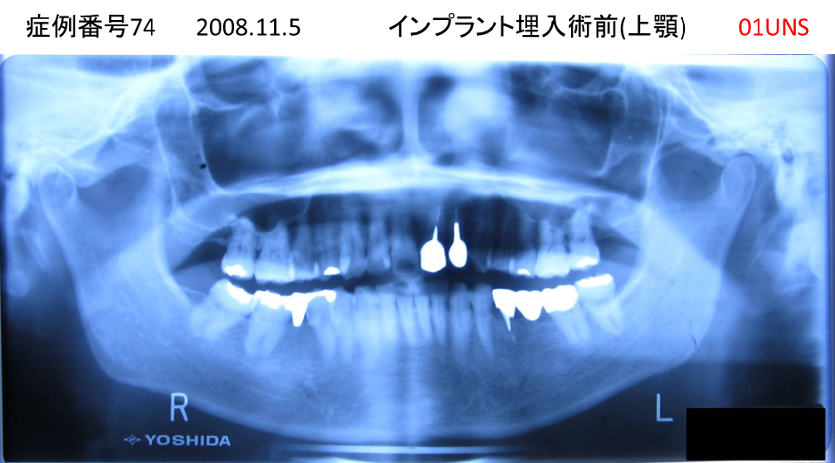 インプラント治療前
