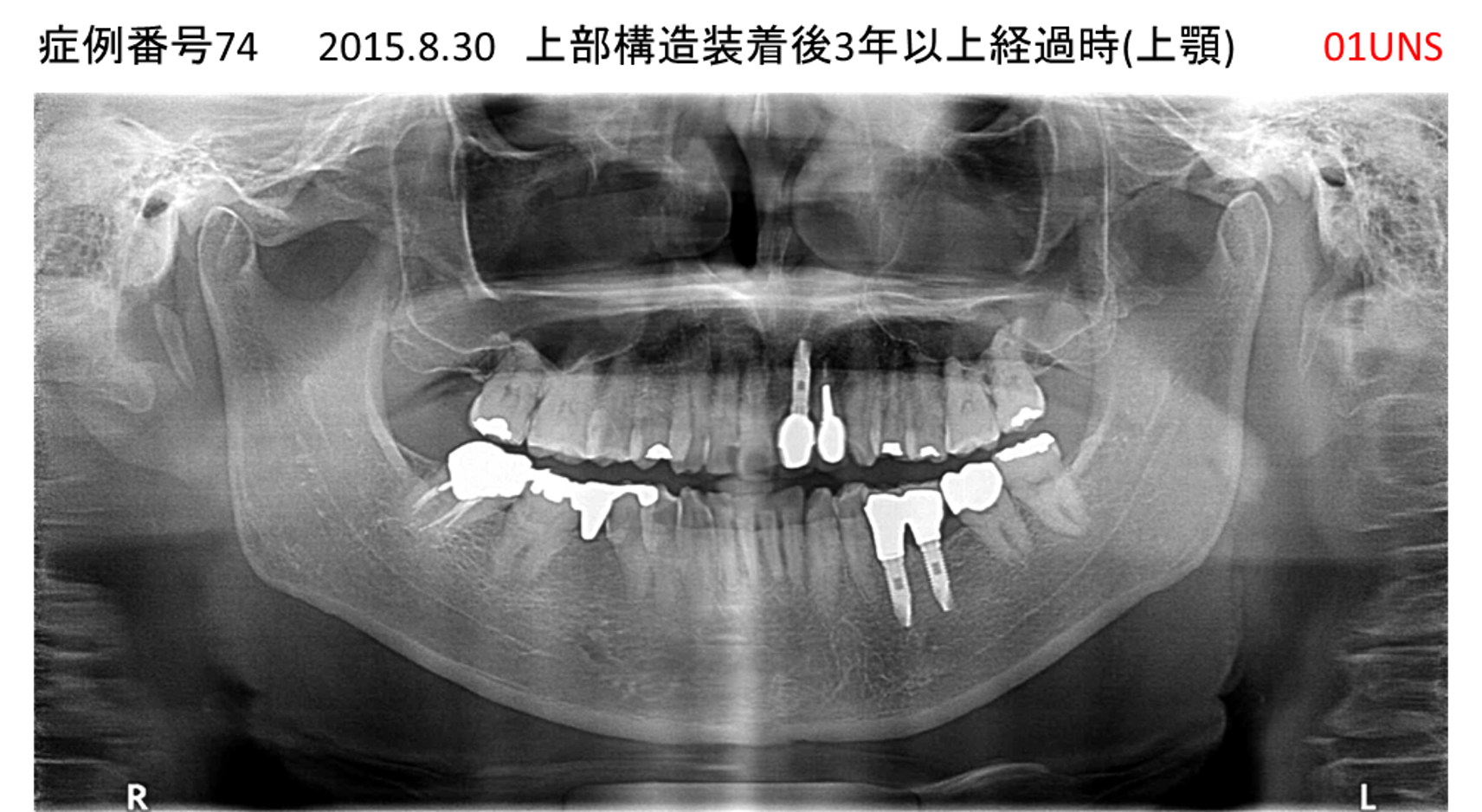 インプラント治療後