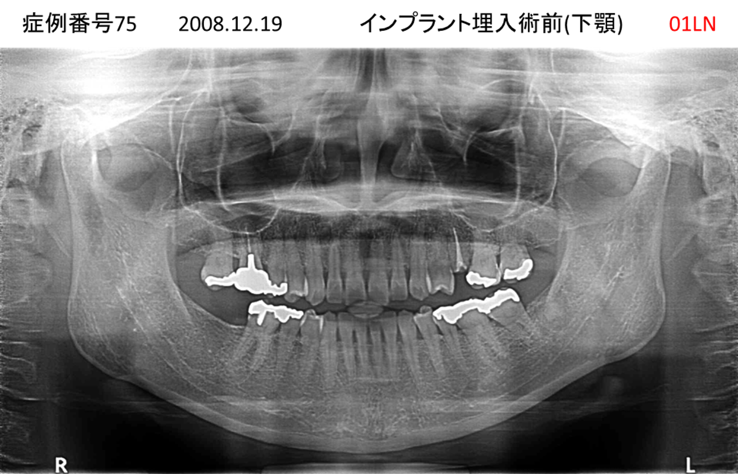 インプラント治療前