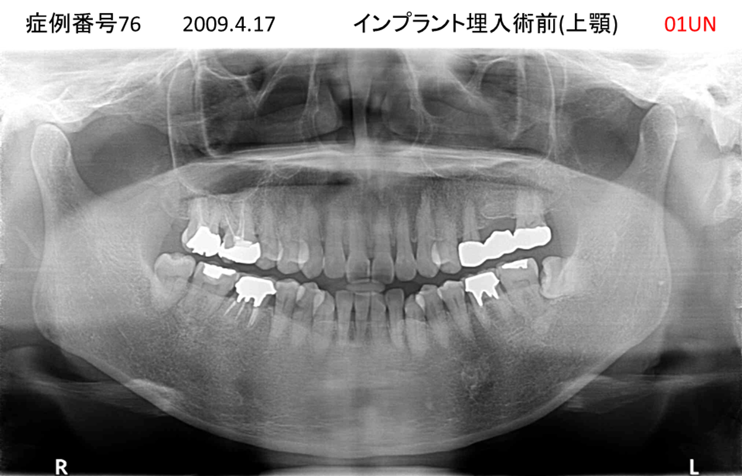 インプラント治療前
