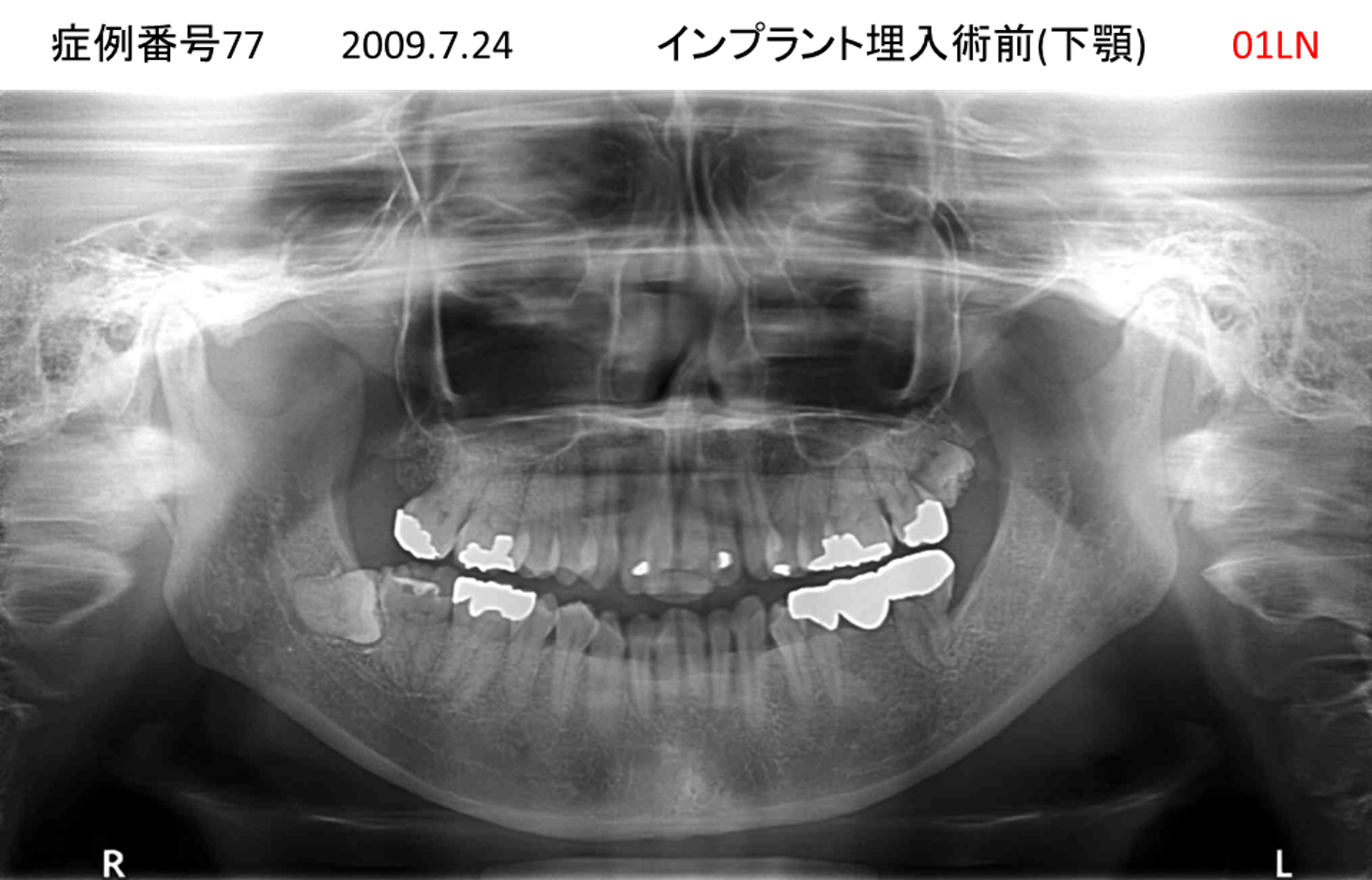 インプラント治療前