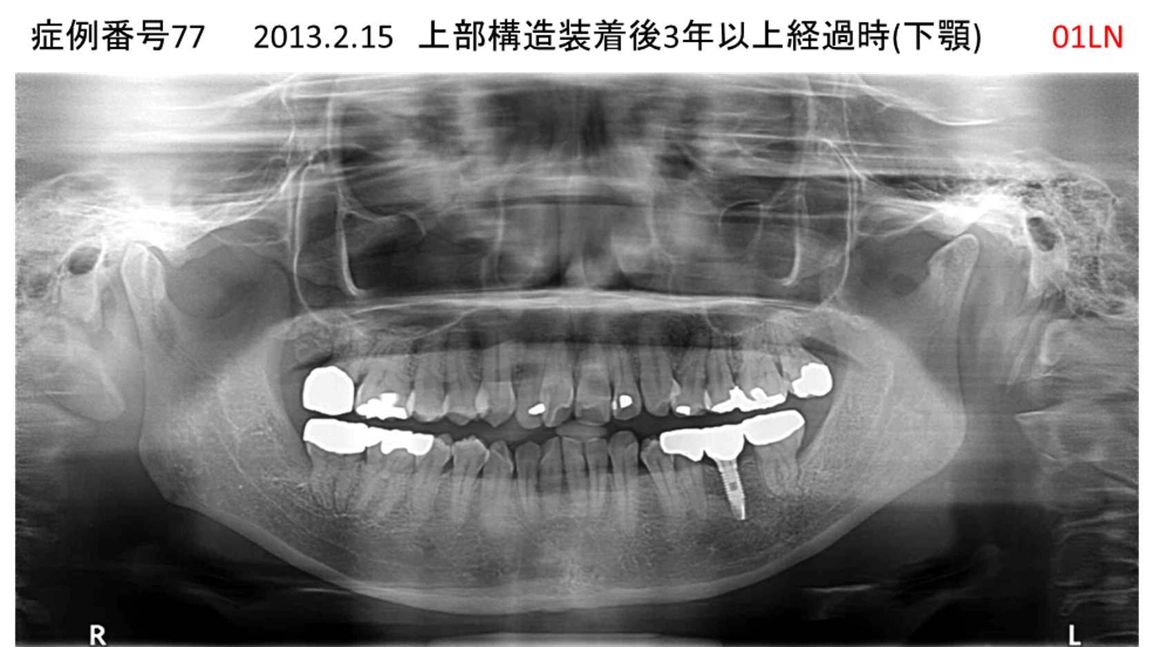 インプラント治療後
