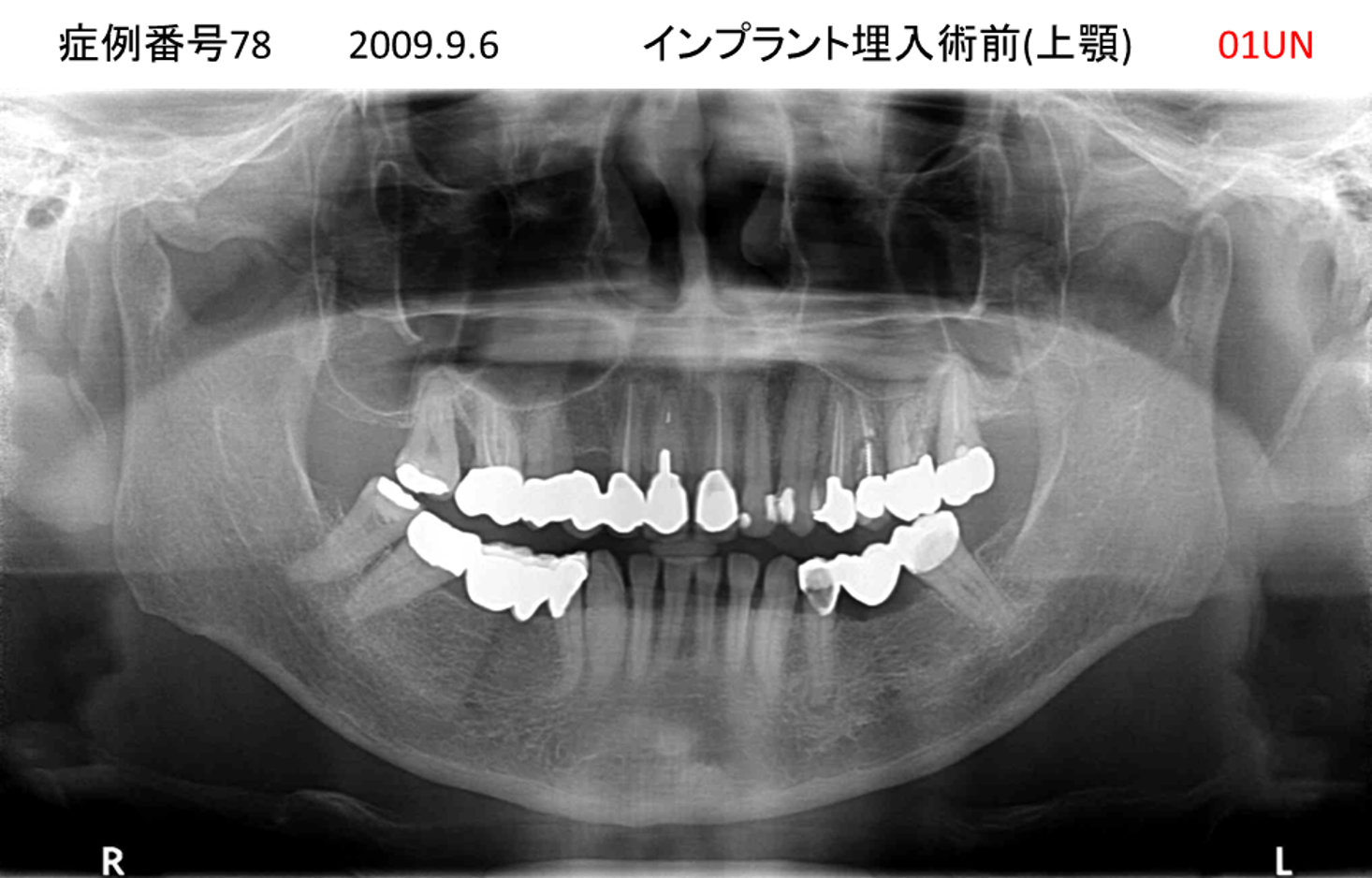 インプラント治療前