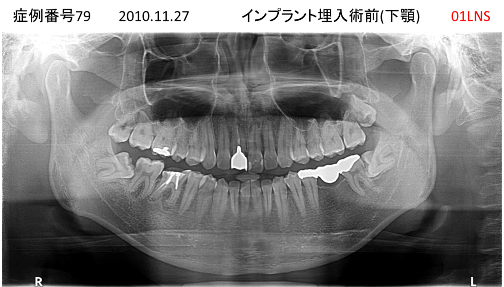 インプラント治療前