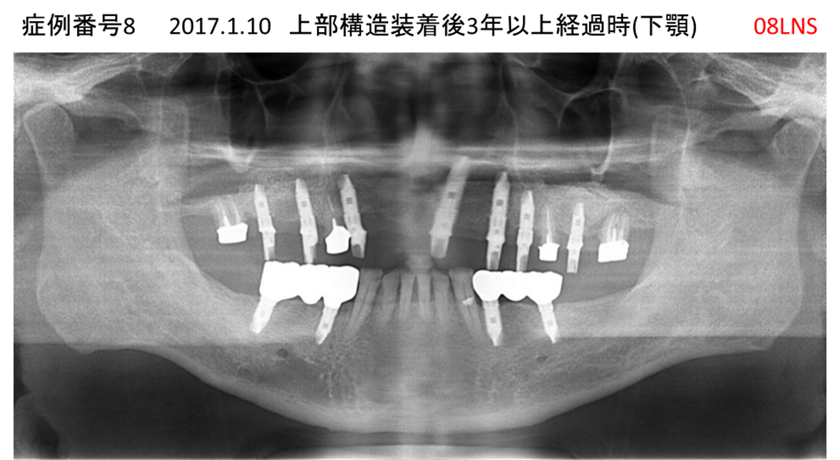 インプラント治療後