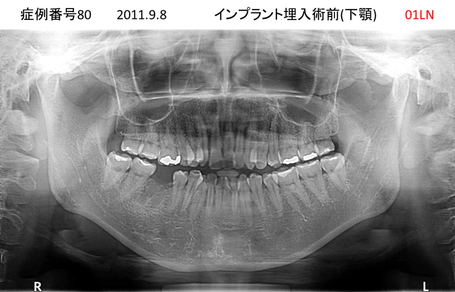 インプラント治療前