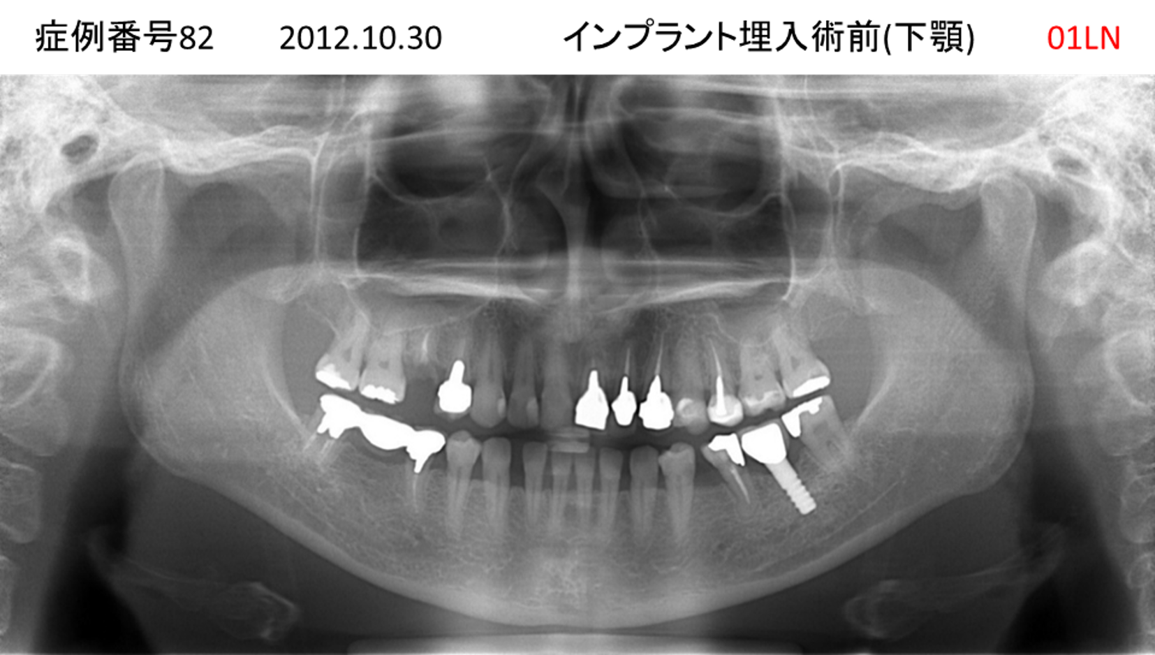 インプラント治療前