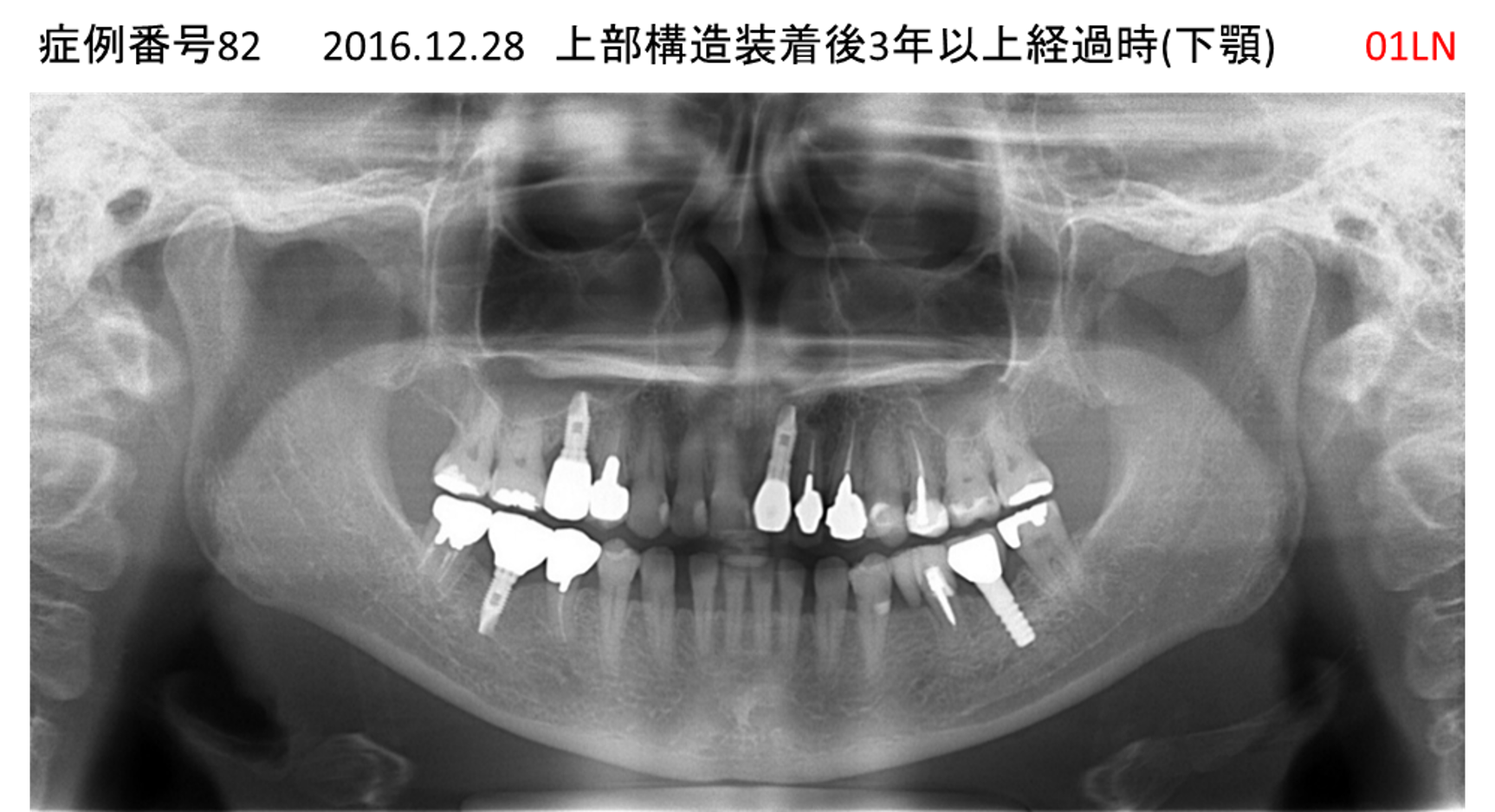 インプラント治療後