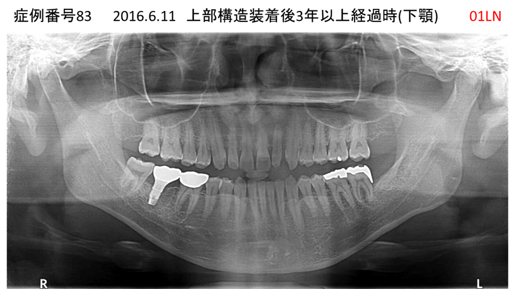 インプラント治療後