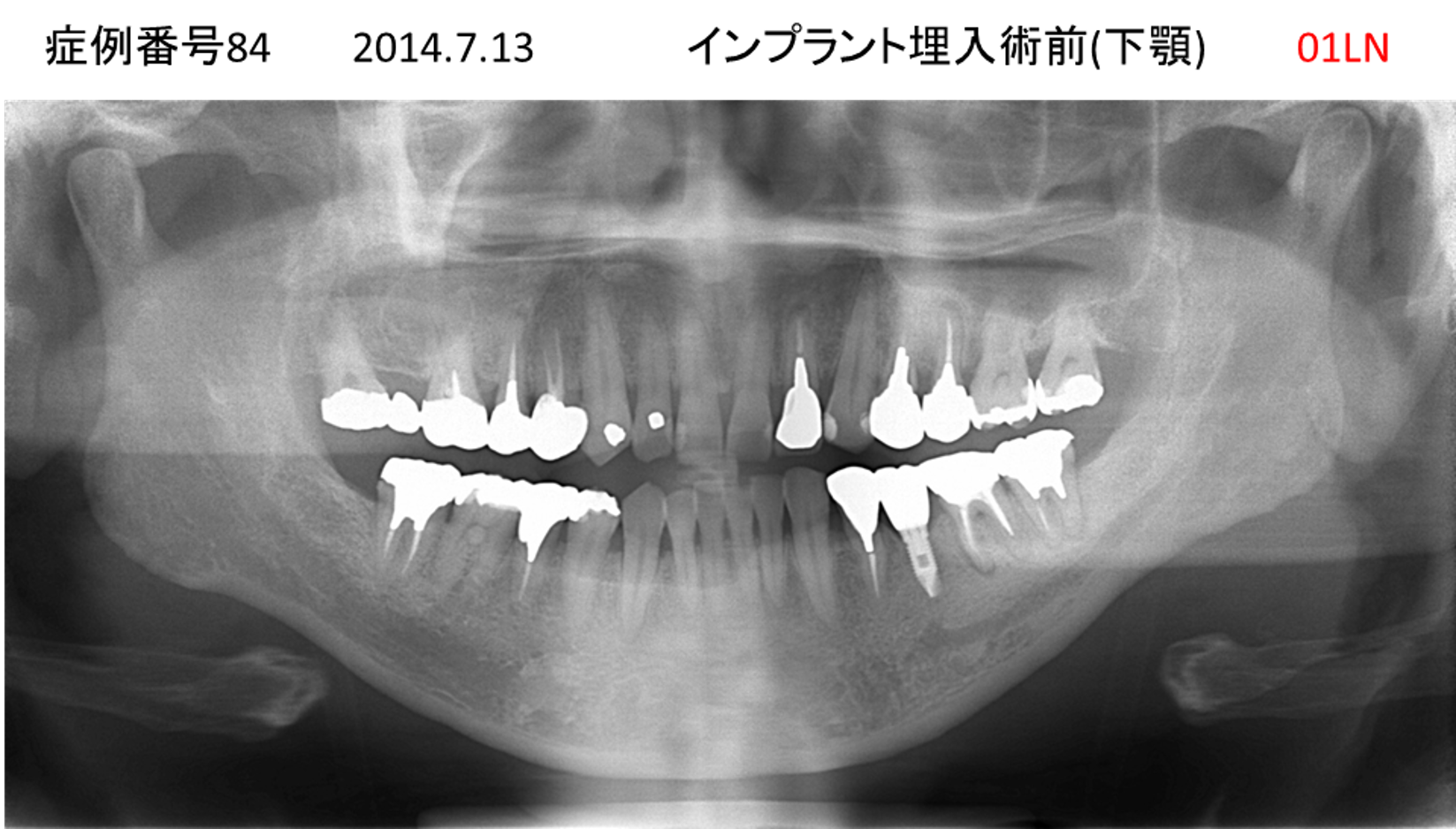 インプラント治療前