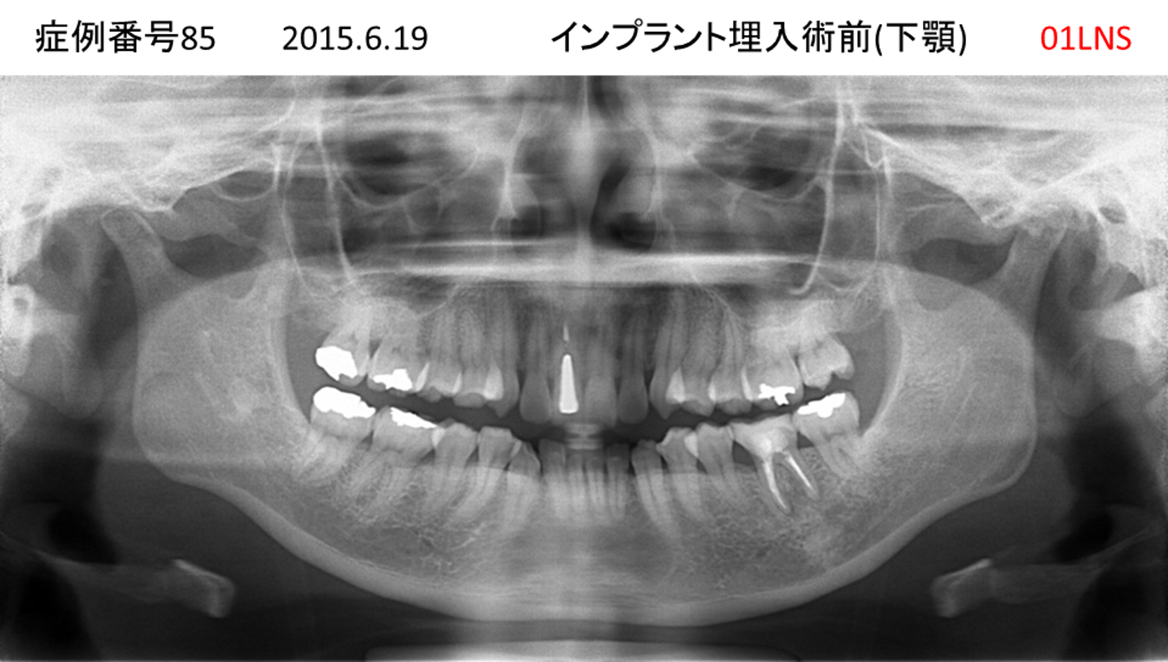 インプラント治療前