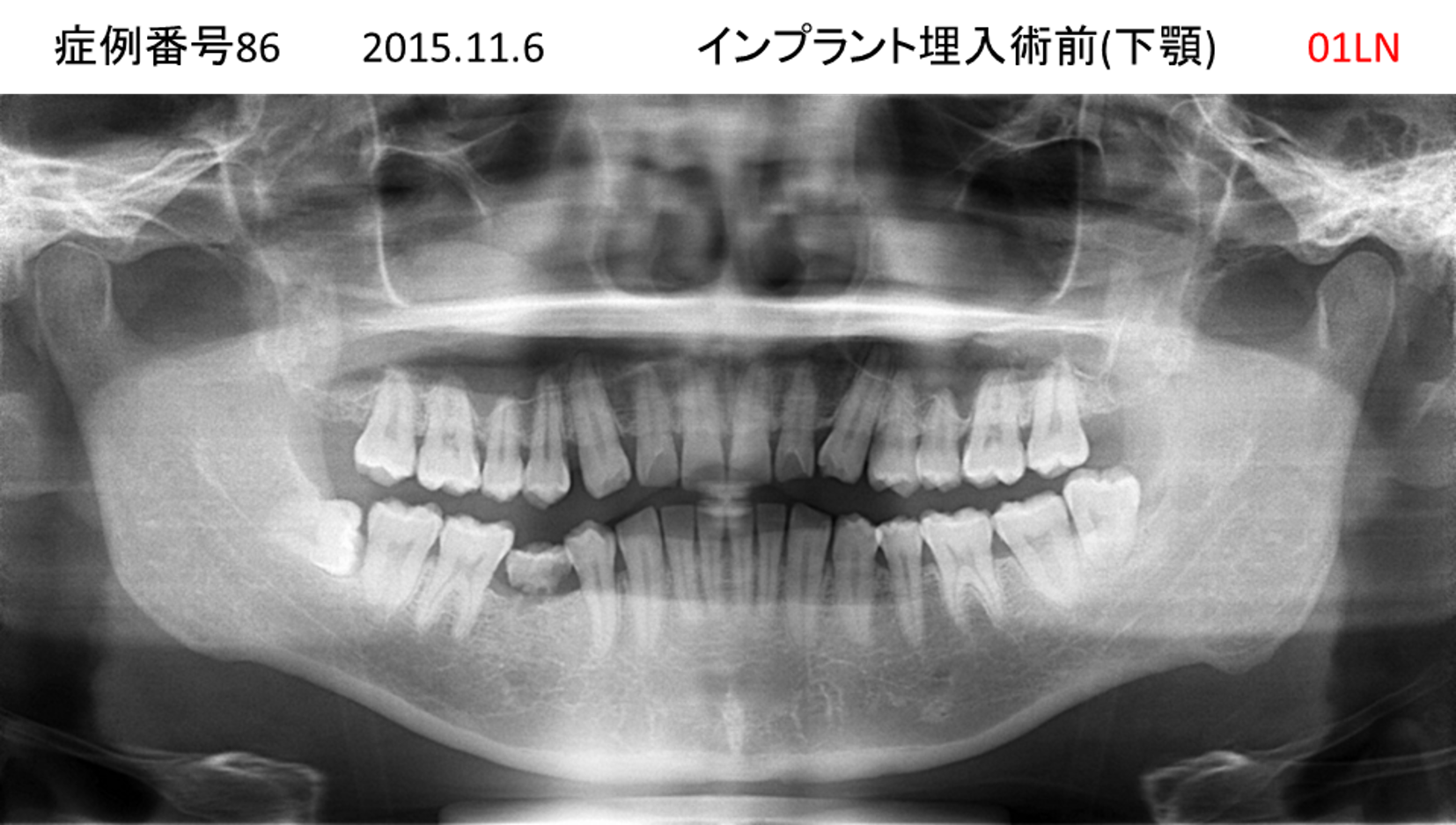 インプラント治療前