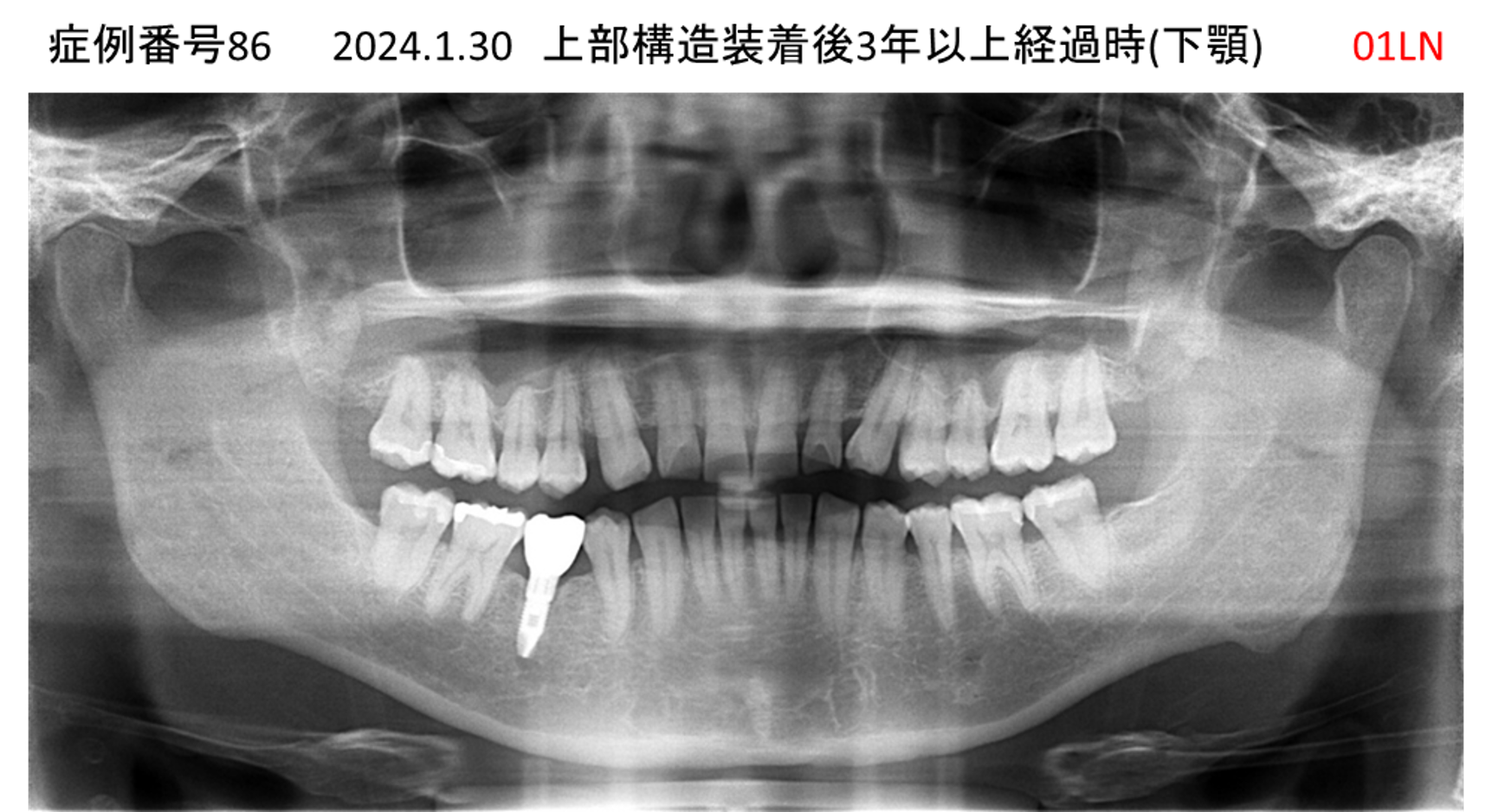 インプラント治療後