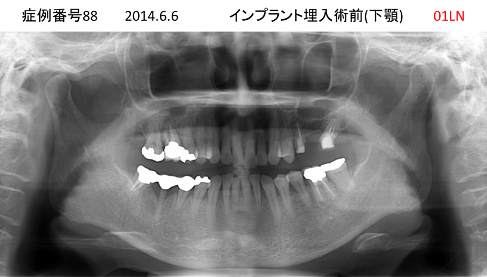インプラント治療前