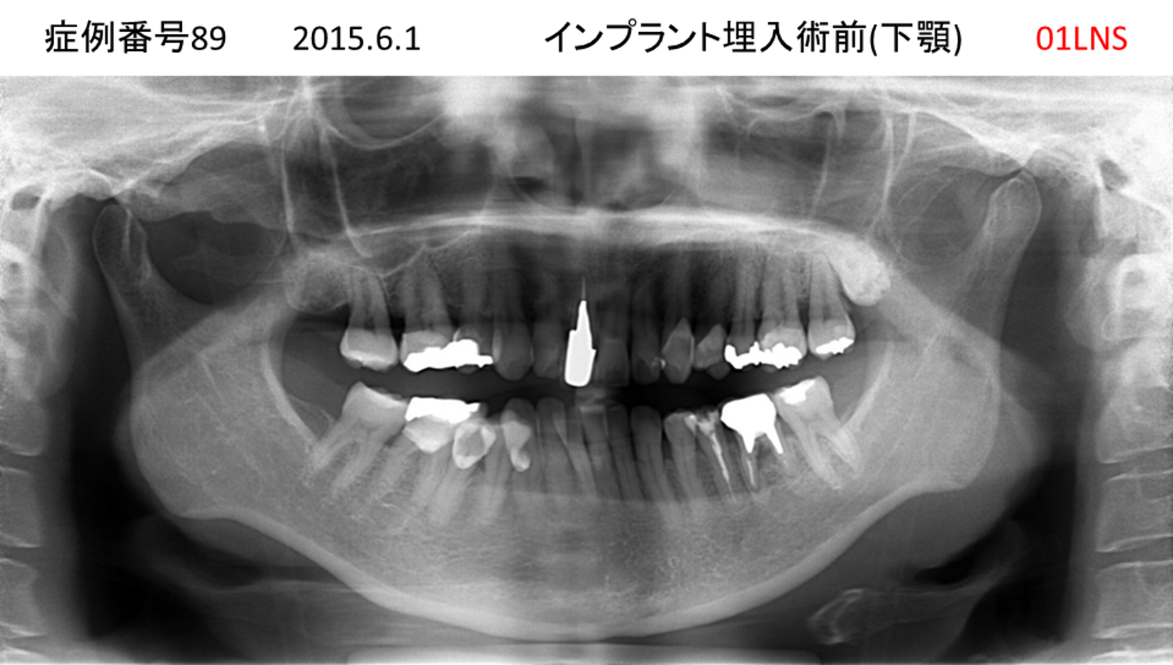 インプラント治療前