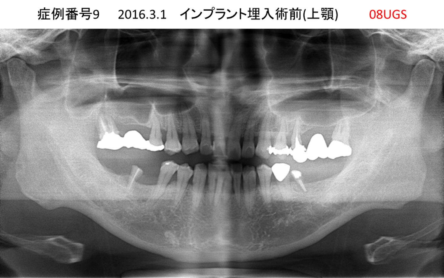 インプラント治療前
