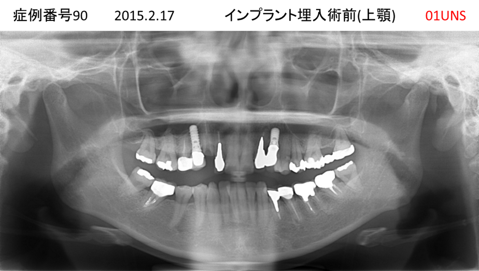インプラント治療前