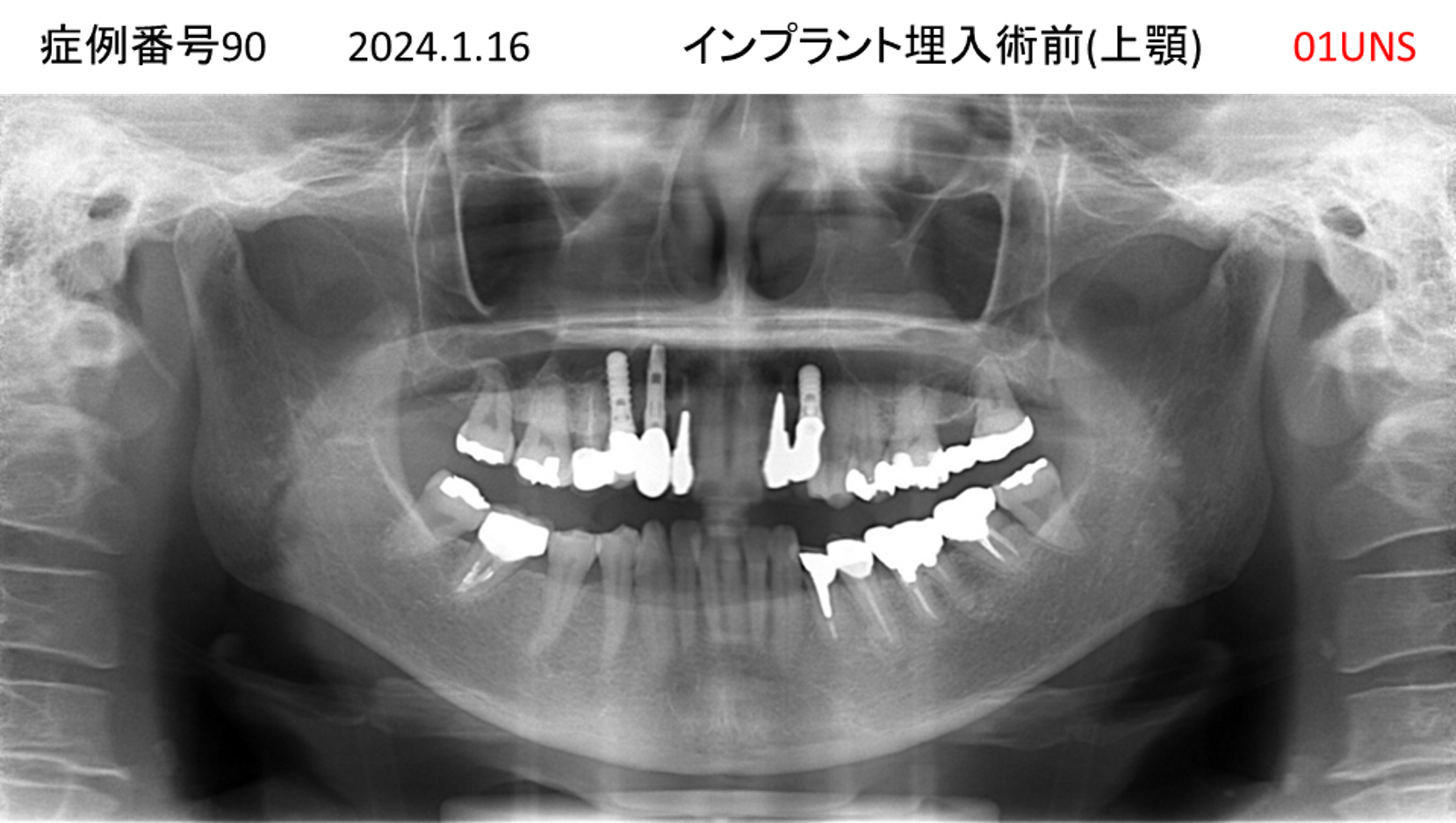 インプラント治療後